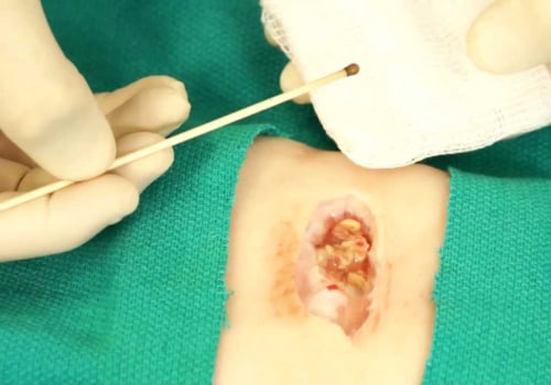 The Truth About Using Silver Nitrate on Open Wounds